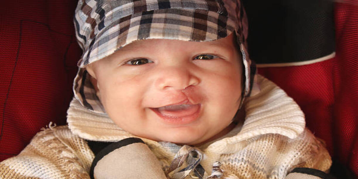 Is Cleft Lip Surgery Cost In India Affordable? | Cleft Lip Surgery 2022