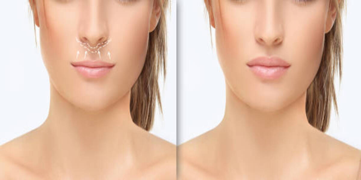 Lip Reduction Surgery In Kerala: Achieving Balanced And Proportionate Lips