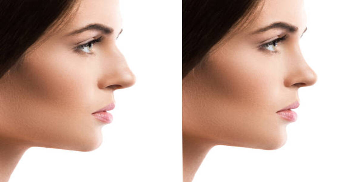 Best Revision Rhinoplasty Surgery In India
