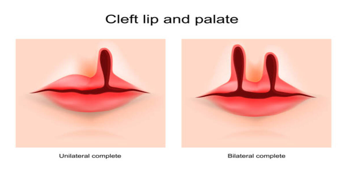 Best Scar-Free Cleft Lip Surgery In India 2022- All You Need To Know