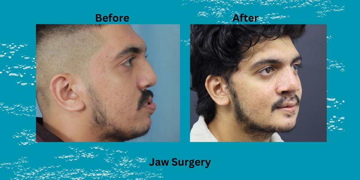 Best Jaw Surgeon in India: Expert Care, Precision Surgery, and Real Transformations