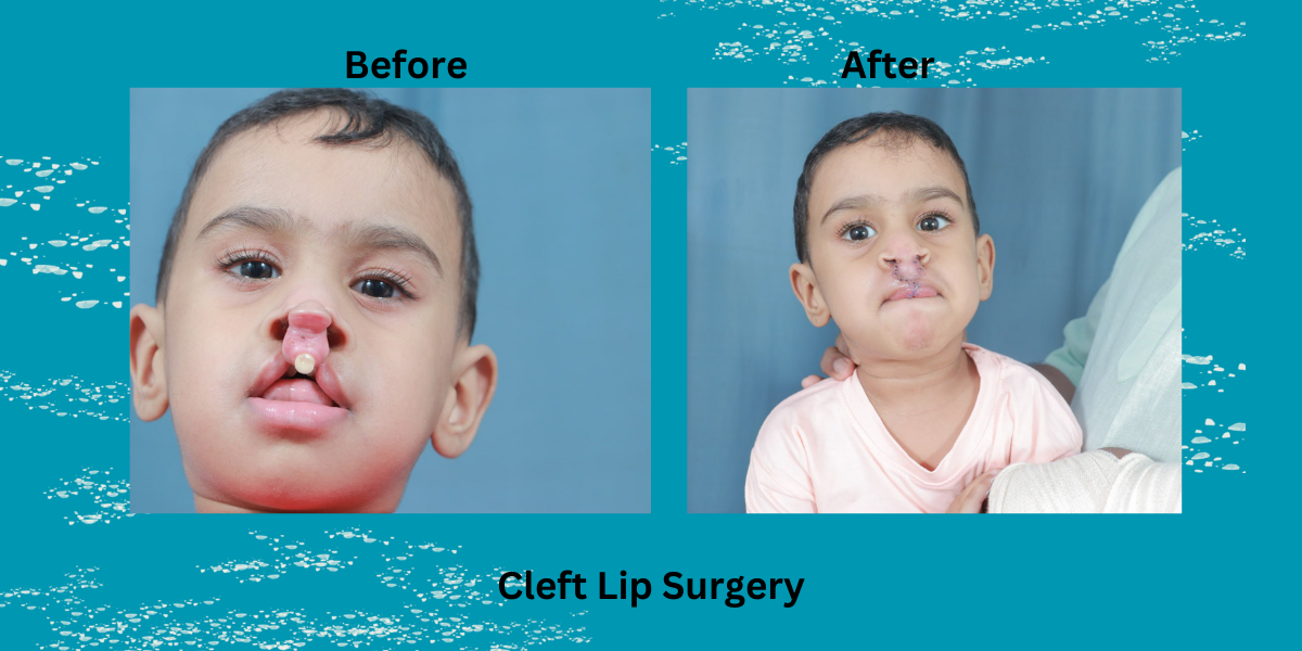Who Is the Best Cleft Lip Surgeon in India? Dr Mathew PC