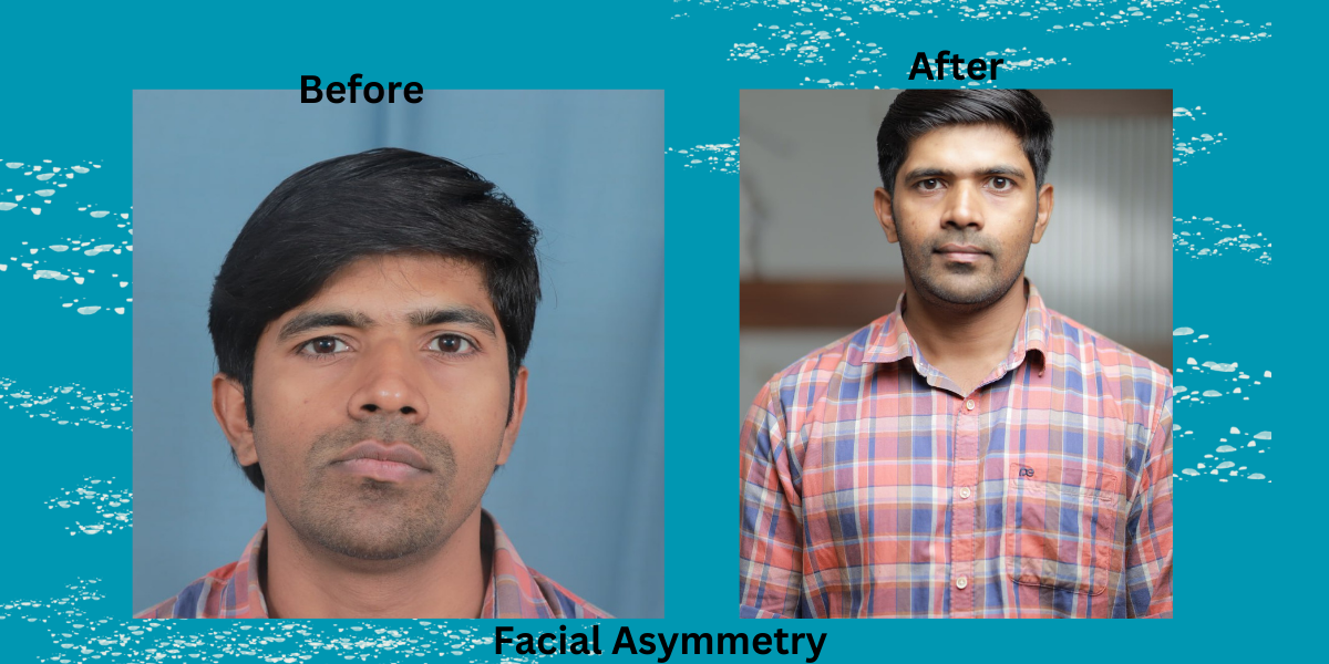 All You Wanted To Know About Asymmetric Face Or Facial Asymmetry