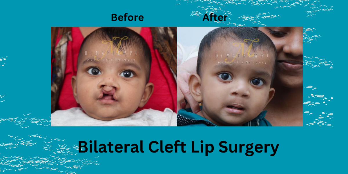 Bilateral Cleft Lip Surgery: What Parents Need to Know for the Best Results