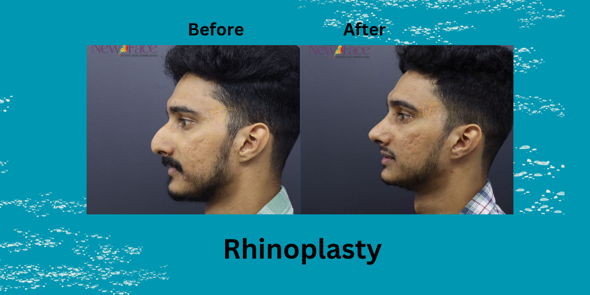 Best Rhinoplasty Surgeon In India 2025 – Dr Mathew PC