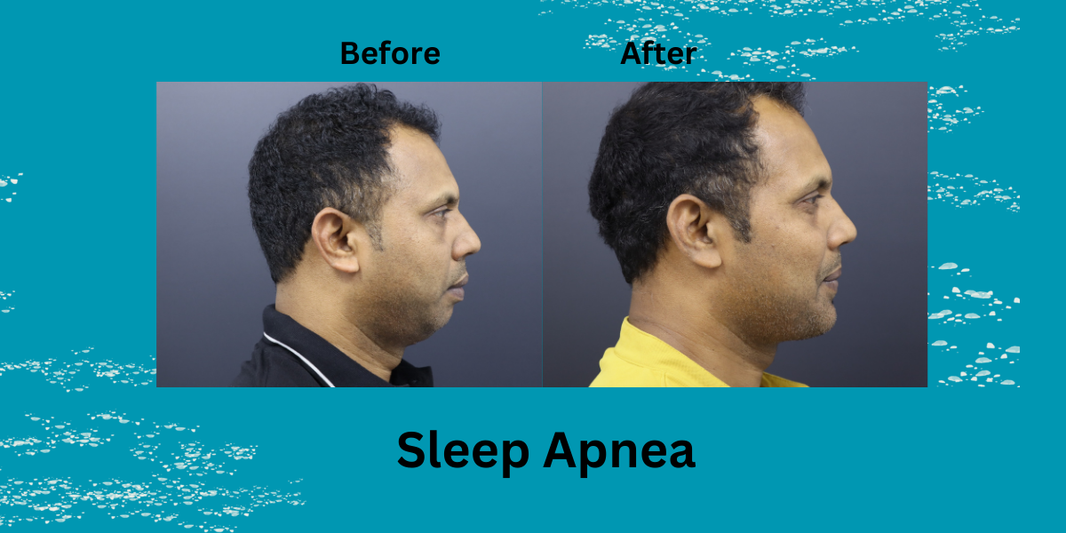 Sleep Apnea Symptoms You Shouldn’t Ignore: A 2025 Patient Guide