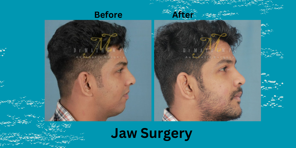 International Patients Guide: Traveling to India for Facial Surgery - Everything You Need to Know