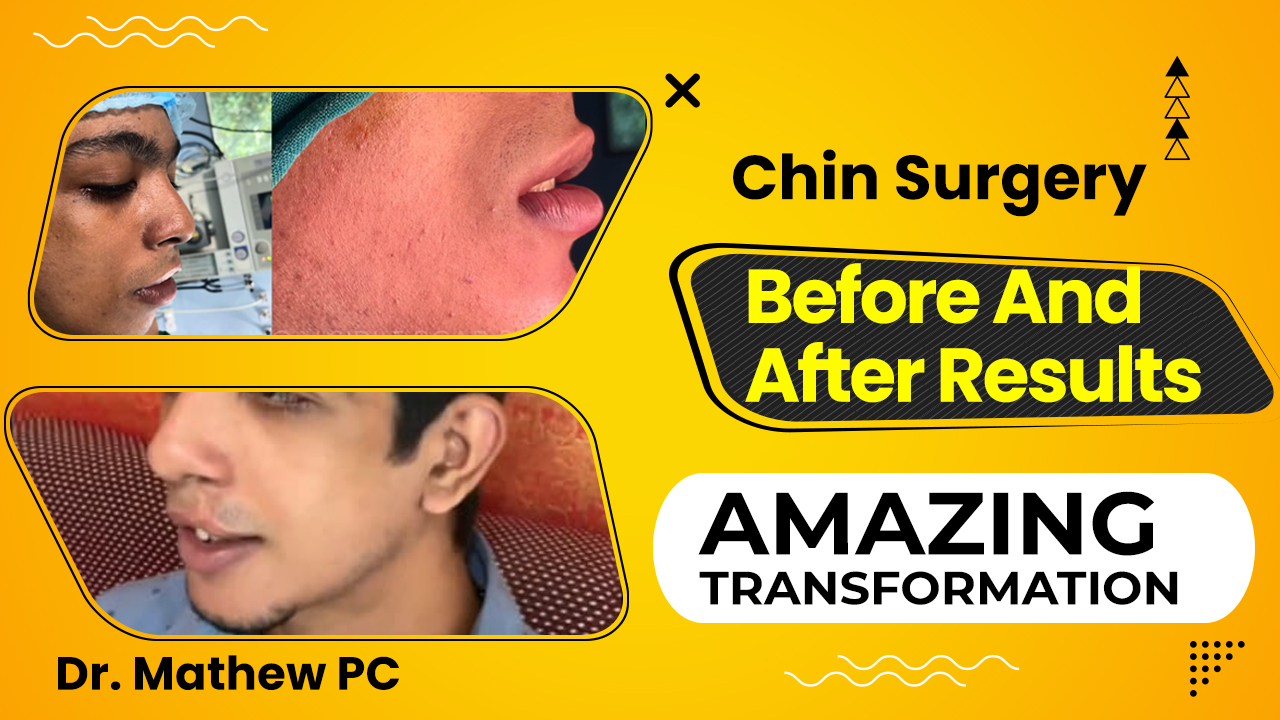 Best Genioplasty In Kerala | Chin Surgery Before & After Results