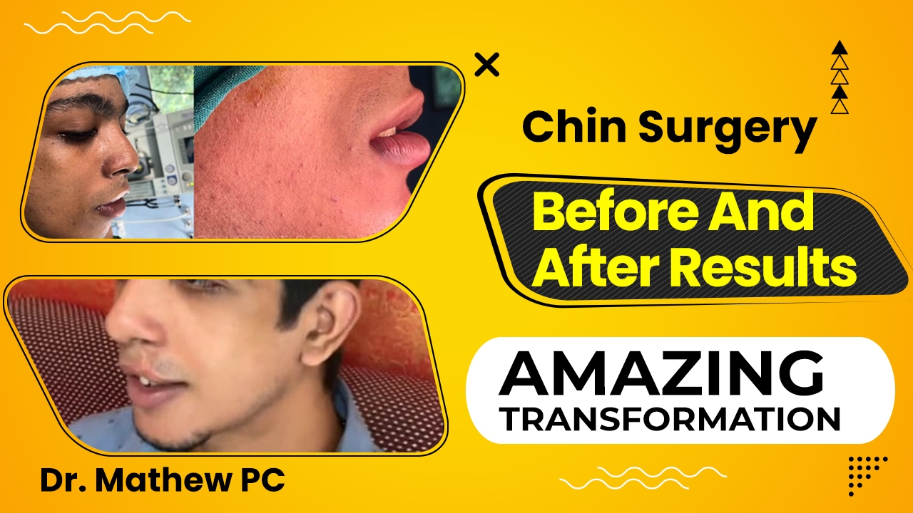 genioplasty in india