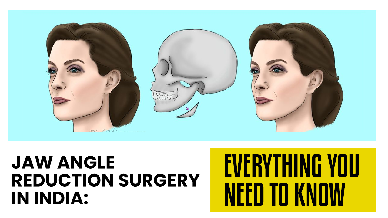 jaw angle reduction surgery in india