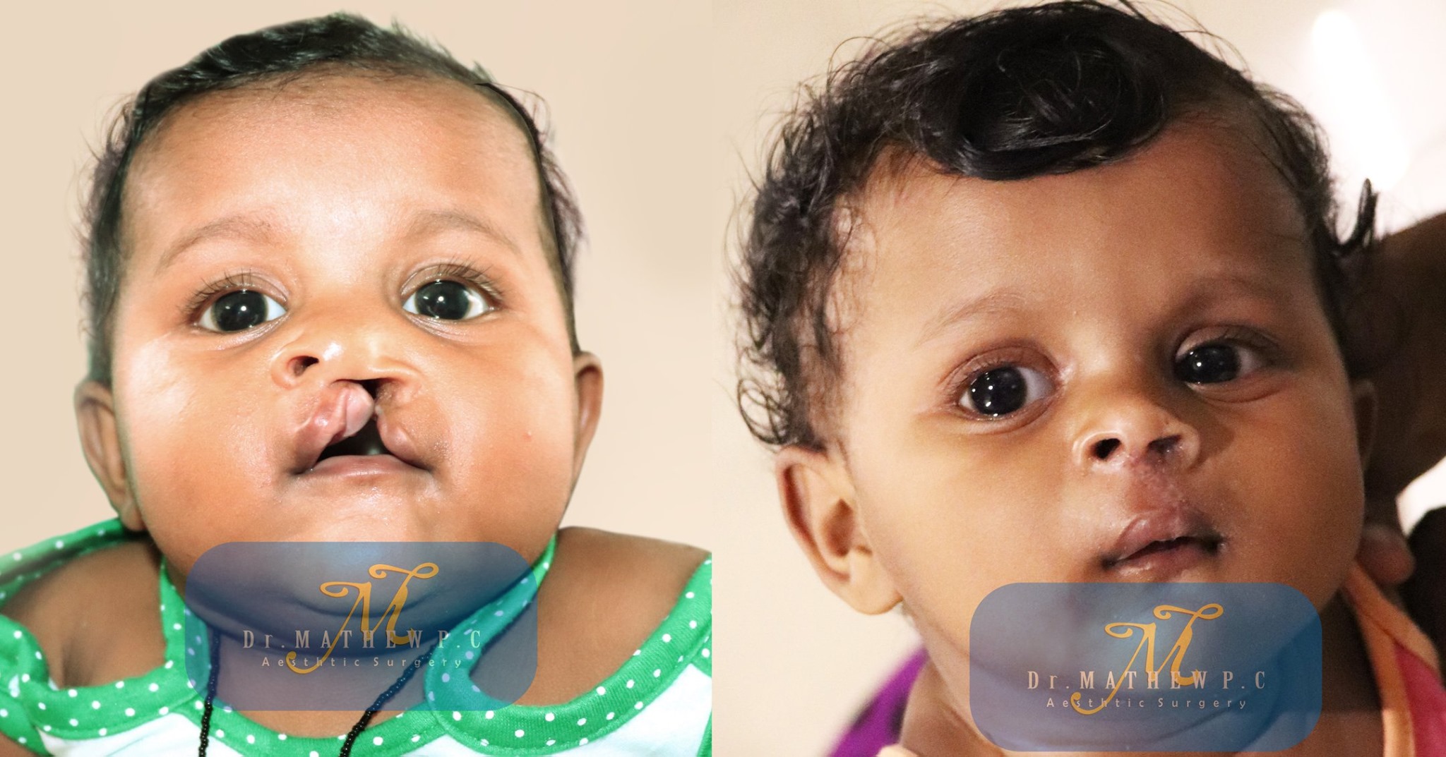 Best Cleft Lip Surgery In Kerala