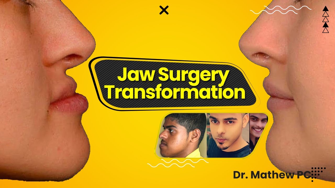 Jaw Implant Surgery In India 2023: Get The Best Custom Treatment!