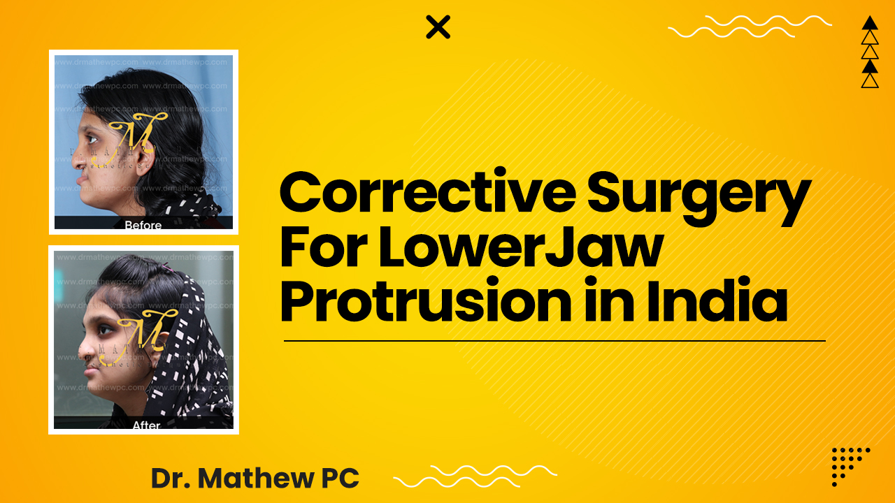 Best Corrective Surgery For Lower Jaw Protrusion In India