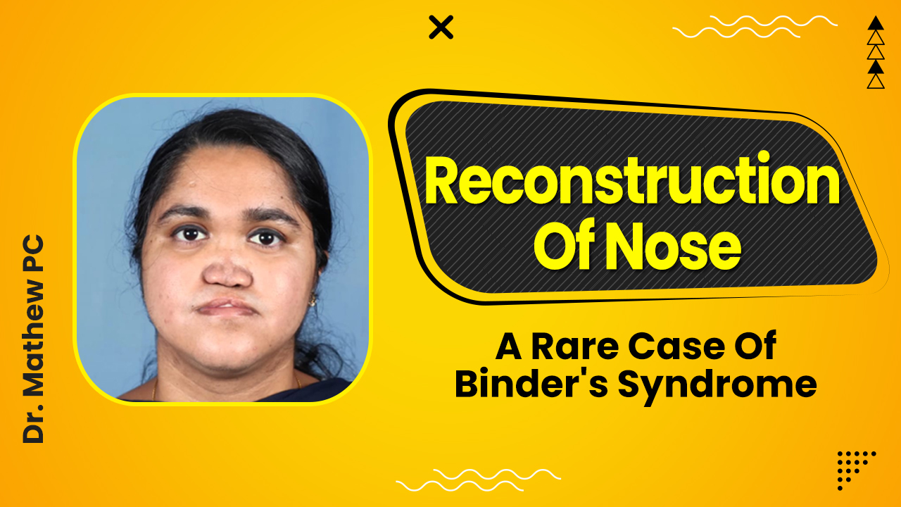 Maxillonasal Dysplasia (Binder’s Syndrome): A Rare Genetic Disorder