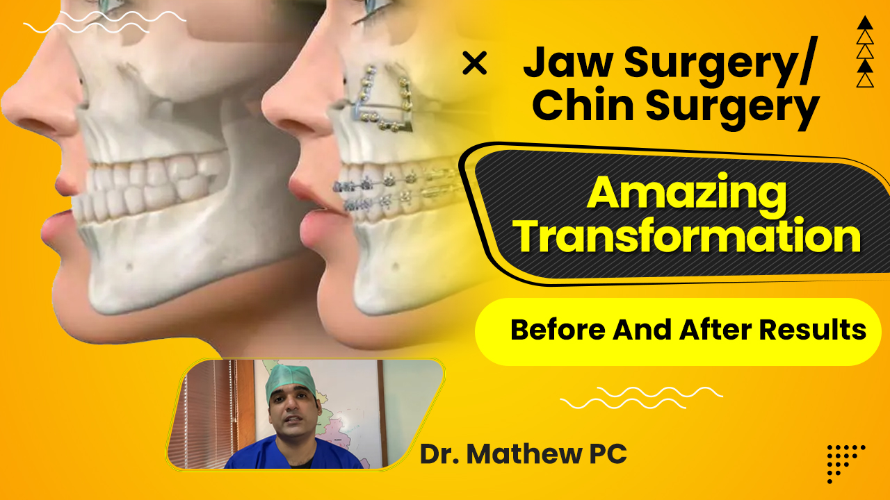 Best Result With Less Jaw Surgery Recovery Time | Orthognathic Surgery 2021