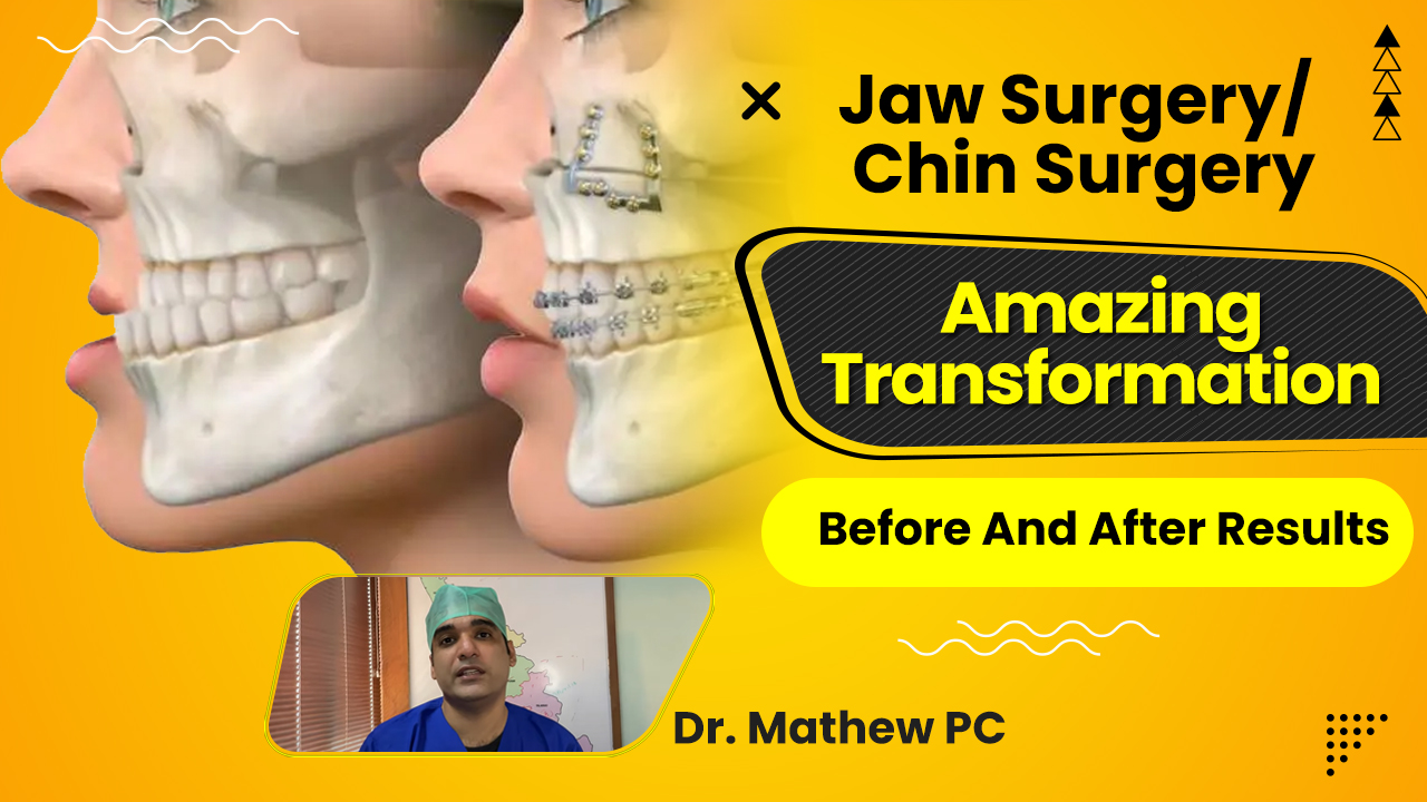 Jaw Surgery in Kerala 2024 | Less Jaw Surgery Recovery Time | Dr Mathew PC