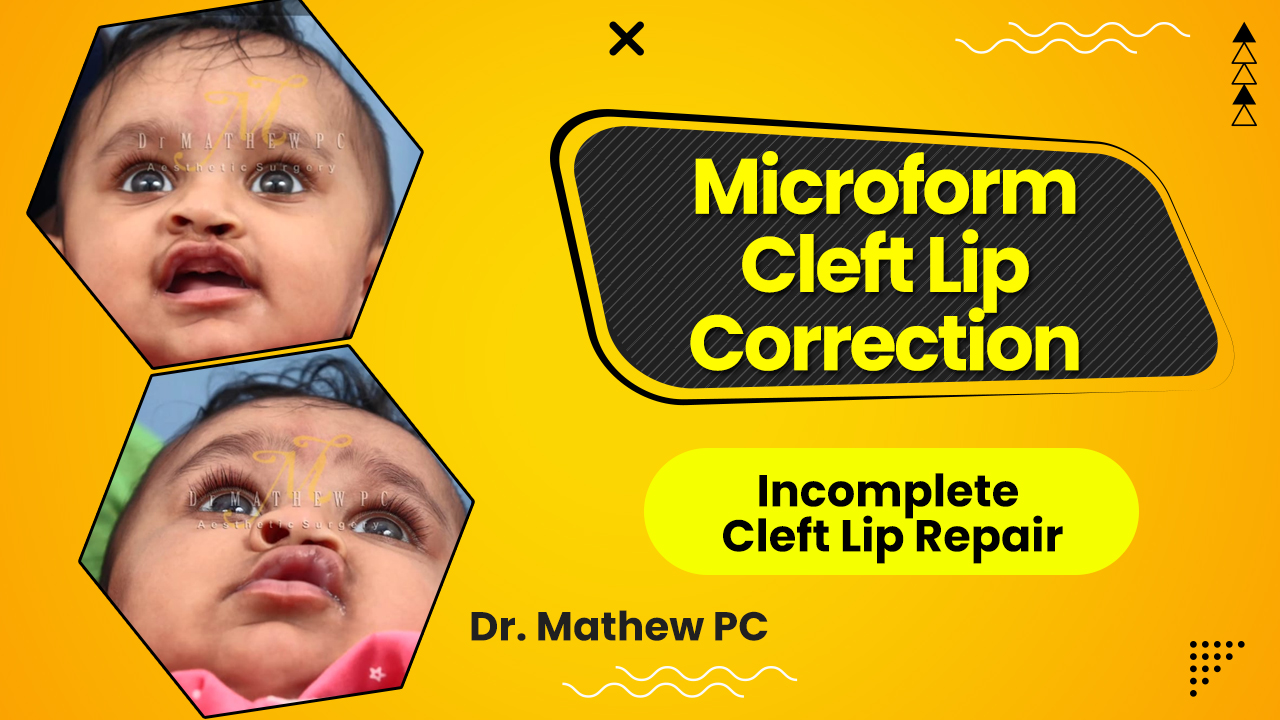 Microform Cleft Lip – An Incomplete Cleft Lip | Best Cleft Lip Surgery