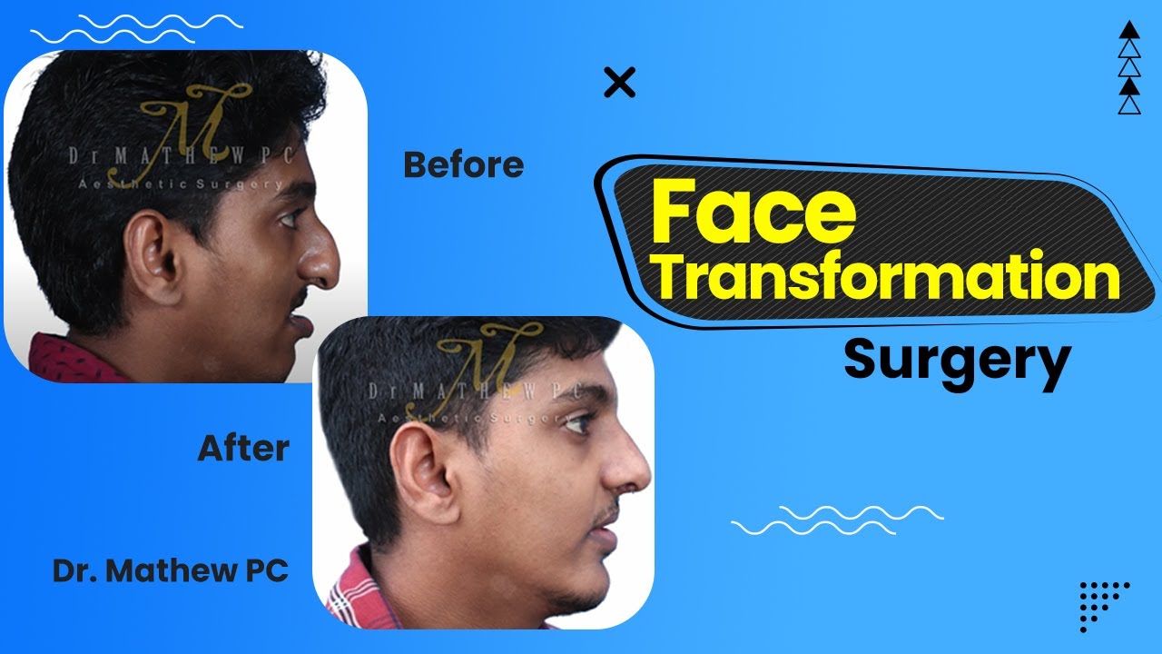 Best Face Transformation Surgery In Kerala | Before & After Results