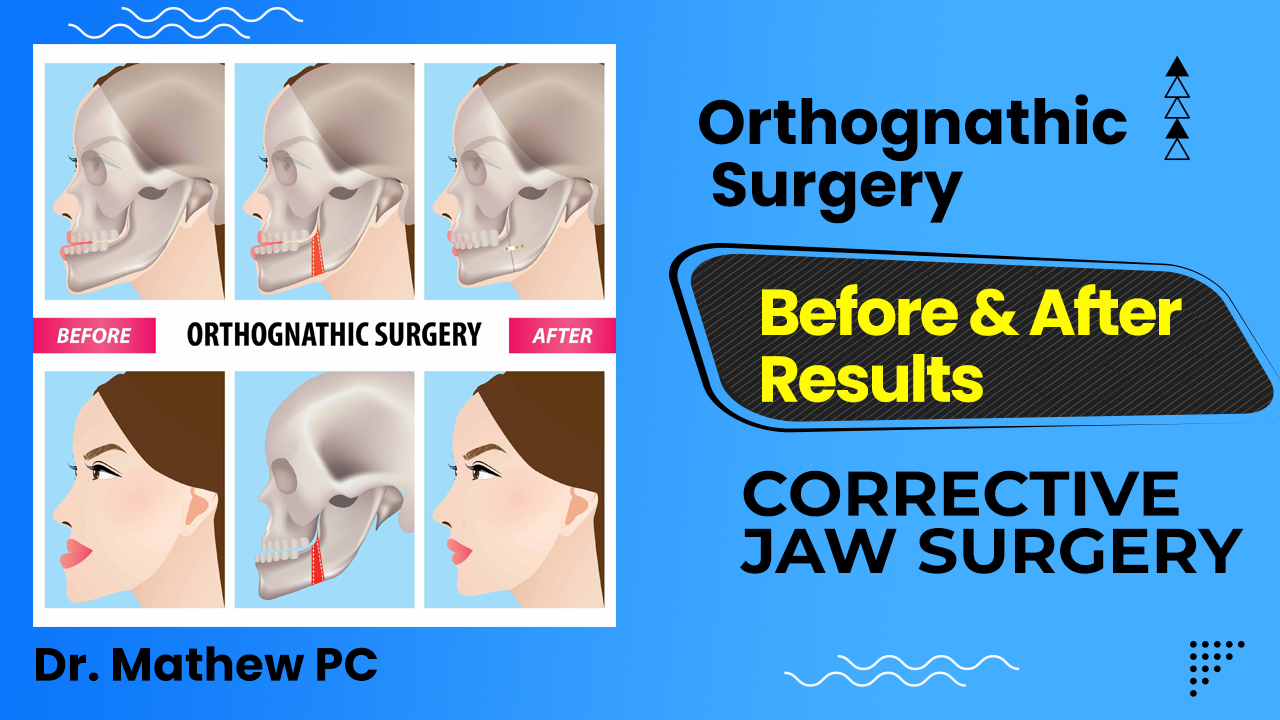 Orthognathic Surgery Before & After Results – Corrective Jaw Surgery In Kerala
