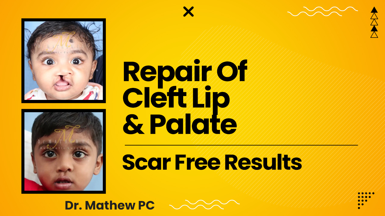 Best Scar-Free Cleft Lip Surgery In India 2022- All You Need To Know