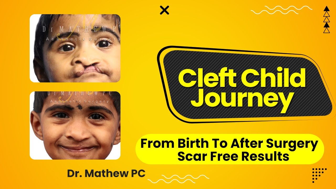 Best Scar Free Cleft Lip Surgery – A New Hope For Cleft Lip Patients