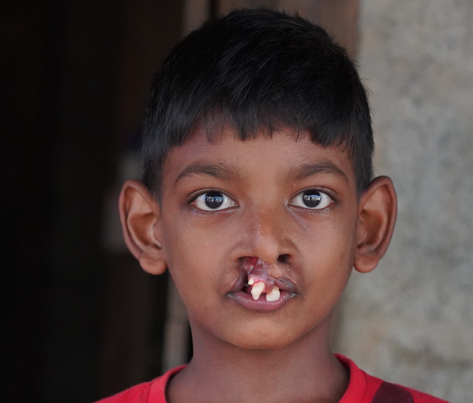 Cleft Lip and Palate Pre-Op