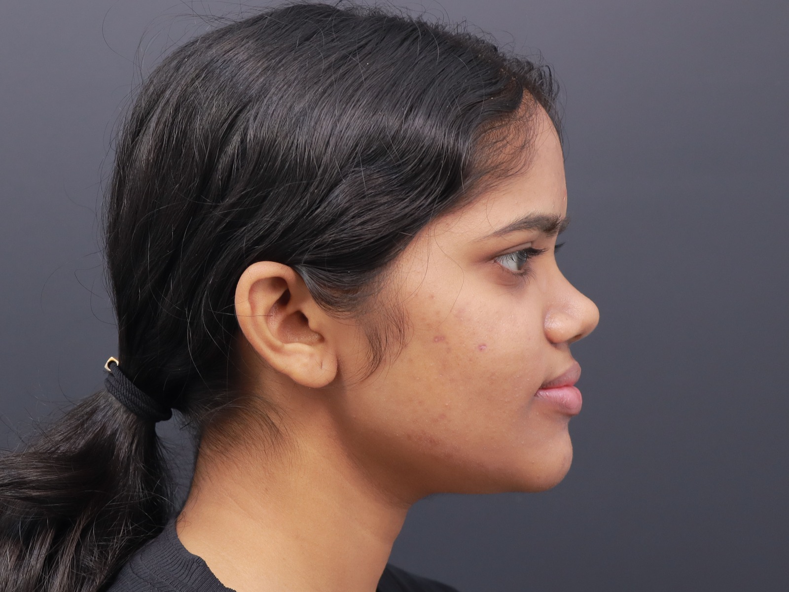 Orthognathic Jaw Surgery Post-Op