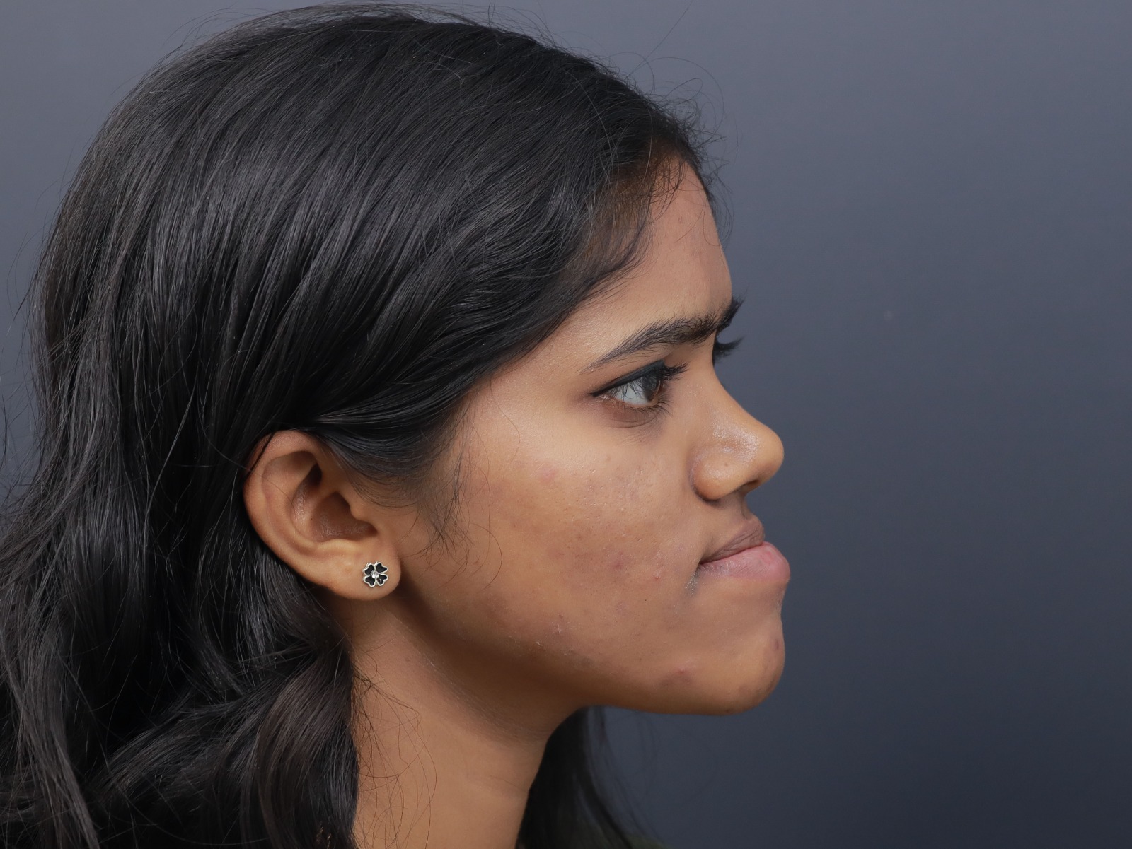 Orthognathic Jaw Surgery Pre-Op