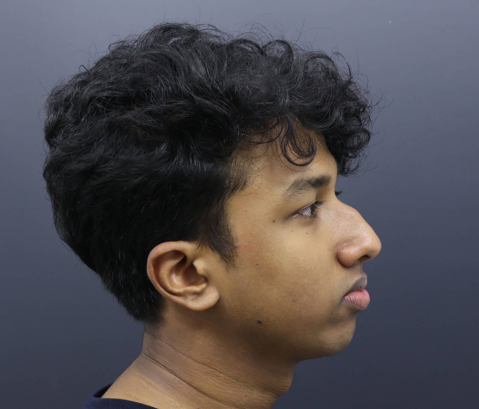 Rhinoplasty Pre-Op