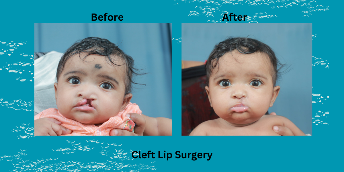 best cleft lip surgeon in india