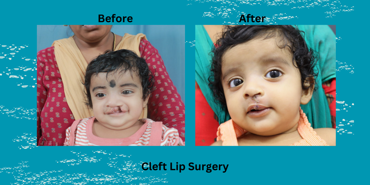 best cleft lip surgeon in india