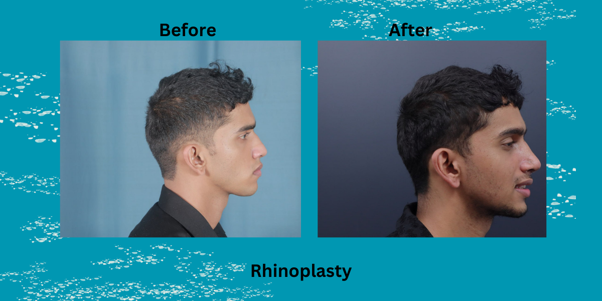 rhinoplasty in kerala