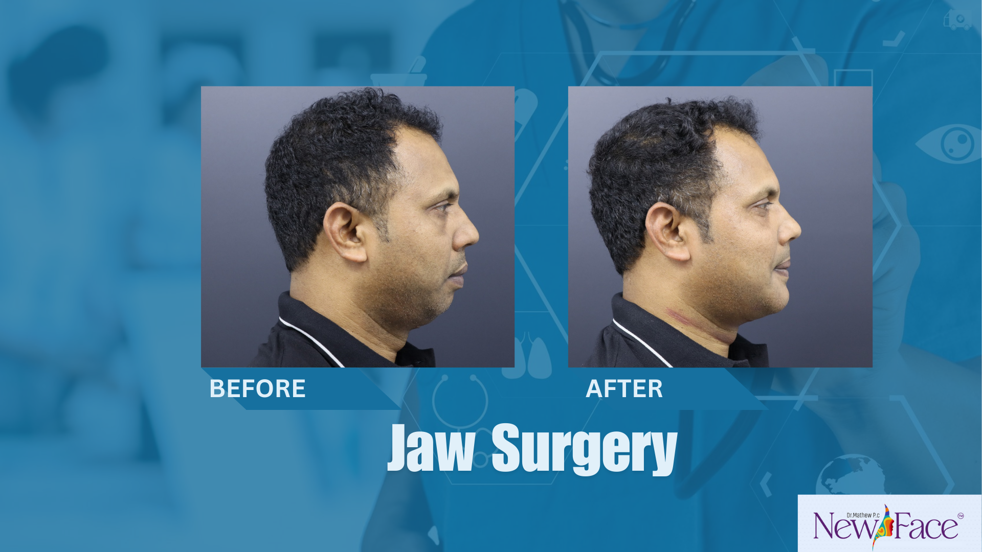jaw surgery in india