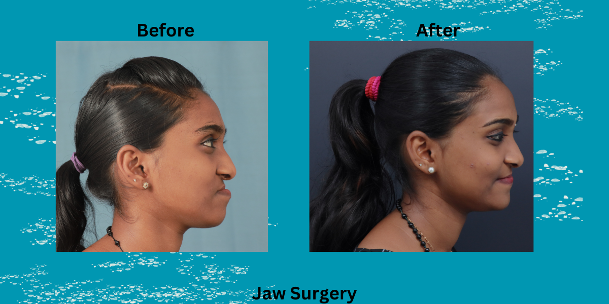 corrective jaw surgery