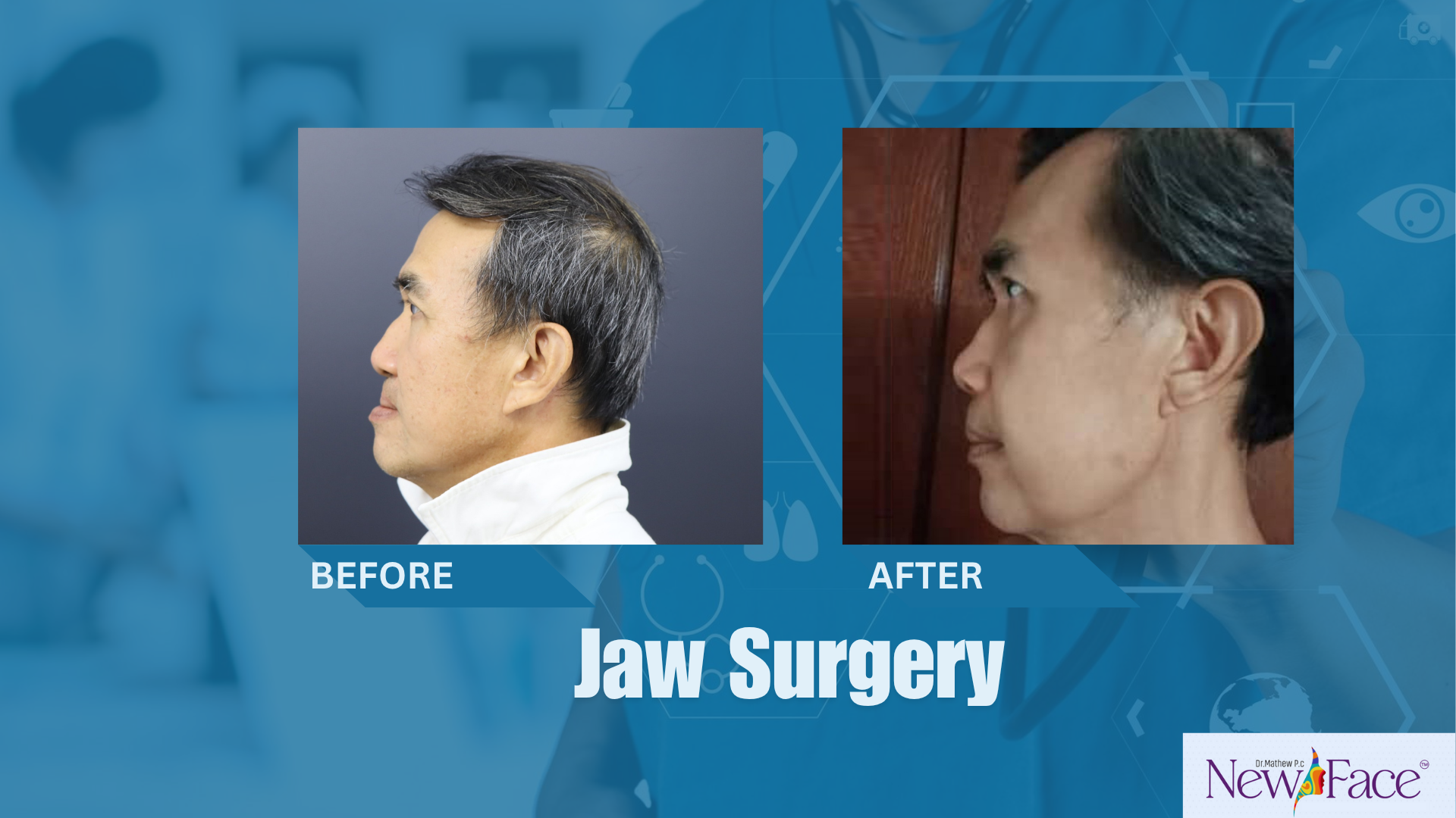 corrective jaw surgery